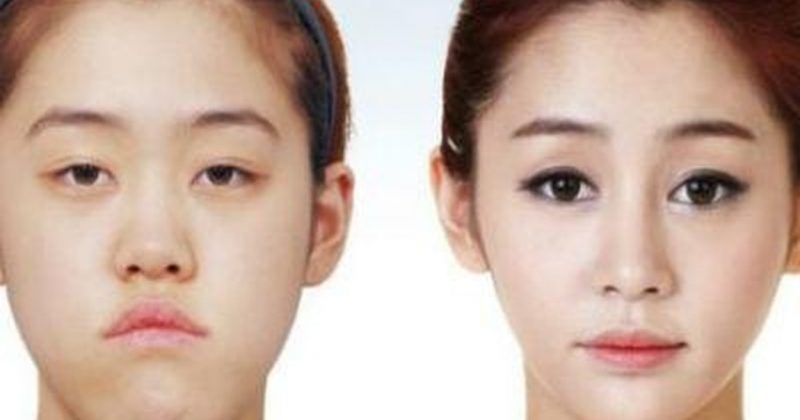 La correction du menton, une chirurgie très en vogue en Corée du Sud