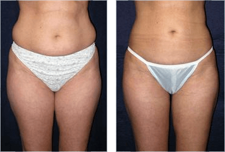 liposuccion ventre et cuisses