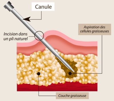 aspiration graisse ventre, cuisses