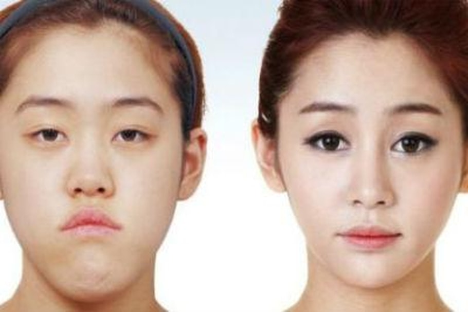 La correction du menton, une chirurgie très en vogue en Corée du Sud