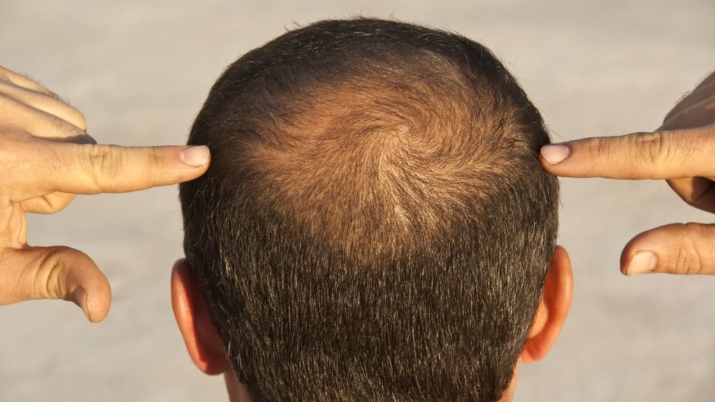 Ce qu’il faut savoir sur les effets secondaires de la greffe des cheveux