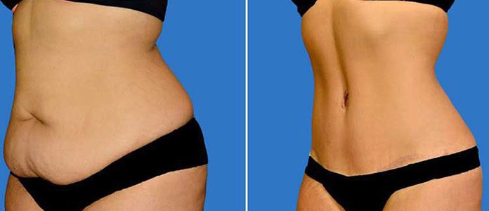 Lipoaspiration vs Plastie abdominale Abdominoplastie-liposuccion