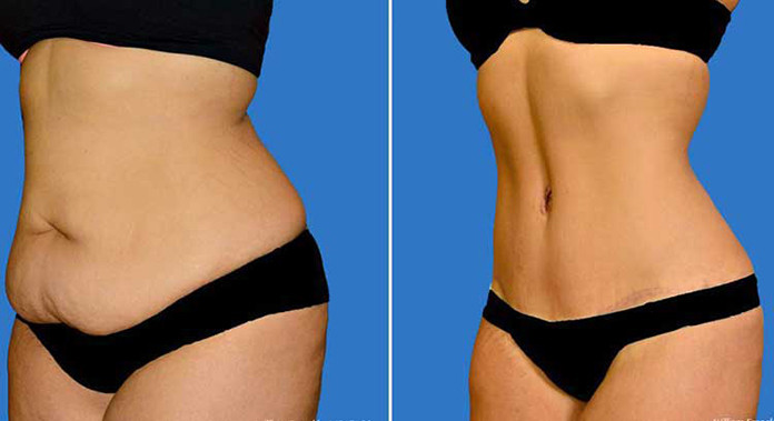 Lipoaspiration vs Plastie abdominale